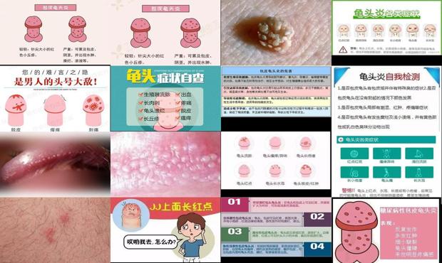 汕头龟头炎的几种图片