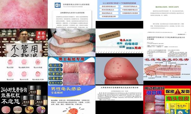 汕头滴虫性龟头炎