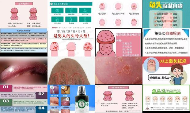 汕头龟头炎4种图片