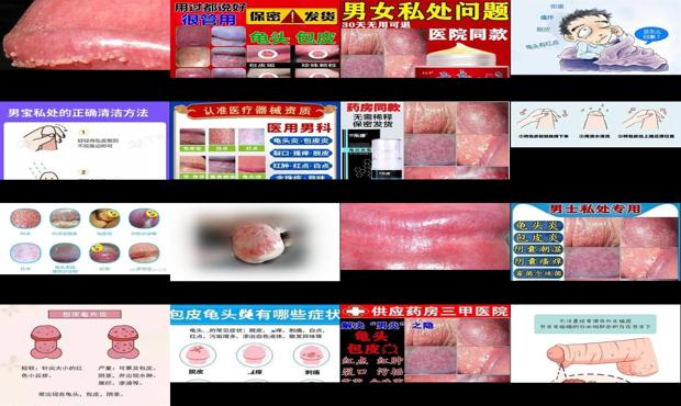汕头包皮炎早期图片