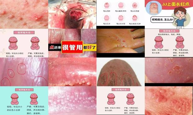 汕头细菌性龟头炎图片