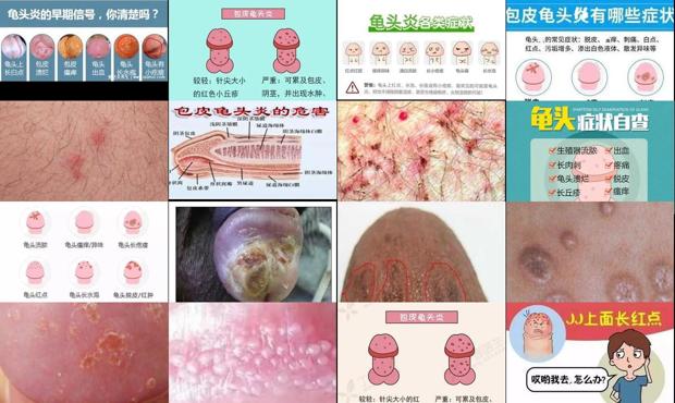 汕头龟头炎的症状图片