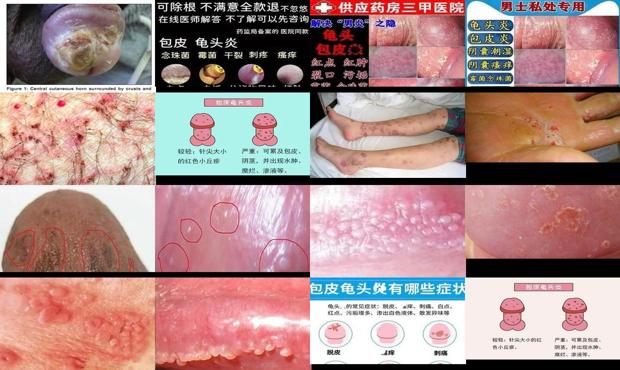 汕头霉菌龟炎图片