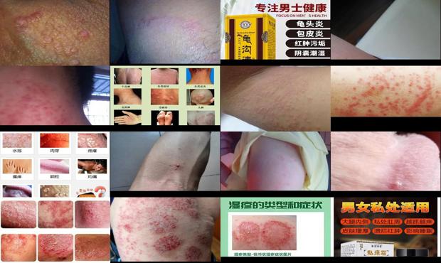 汕头阴茎皮炎湿疹