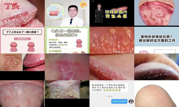 汕头龟头炎疙瘩照片